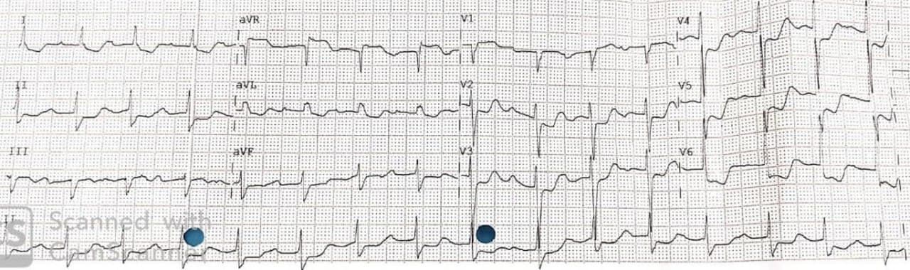 Mujer de 75 años con factores de riesgo que presenta ángor estable hasta hace una semana en que se torna progresivo acompañado de sudoración, náuseas y vómitos por desarrollo de SCA con isquemia circunsferencial por compromiso de TCI y tres vasos