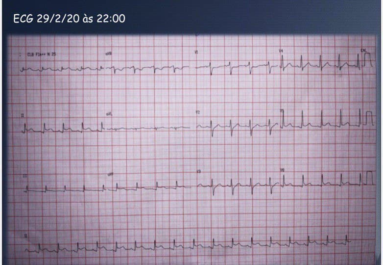 Hombre de 25 años con antecedente inmediato de faringitis hace una semana y que desarrolla cuadro de pericarditos aguda