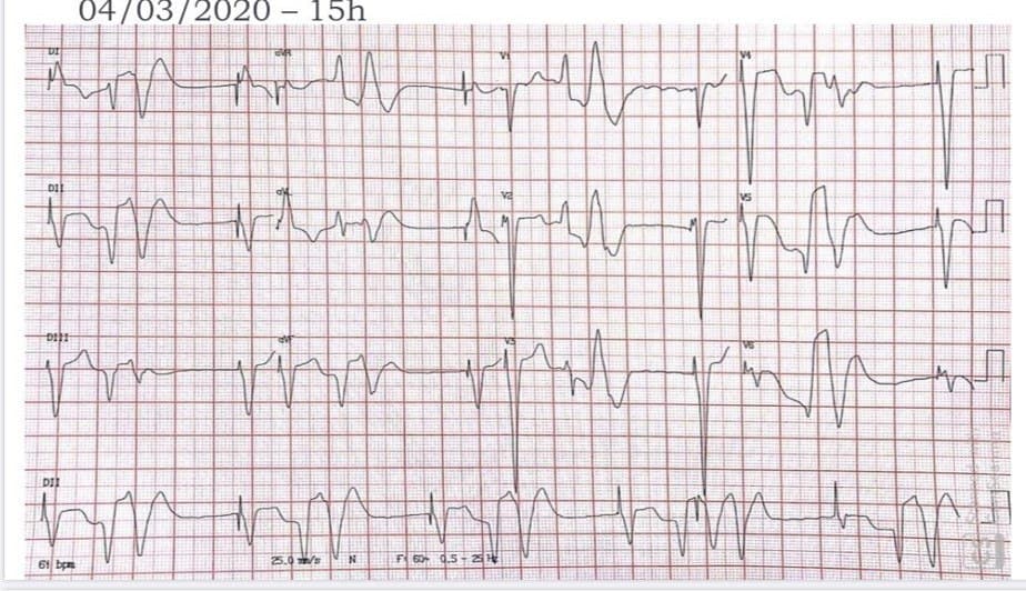 Mujer de 50 años con antecedentes de doble reemplazo valvular mitral y aórtico que cursa con cuadro febril de vías aéreas que es tratado con azitromicina y desarrolla SQTL con episodios de TdP que la llevan al óbito