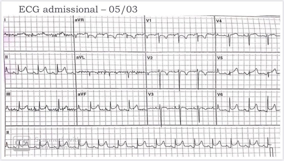 Mujer de 79 años portadora de EPOC con empeoramiento de la disnea habitual y presencia de dolor interescápulovertebral por pericarditis aguda