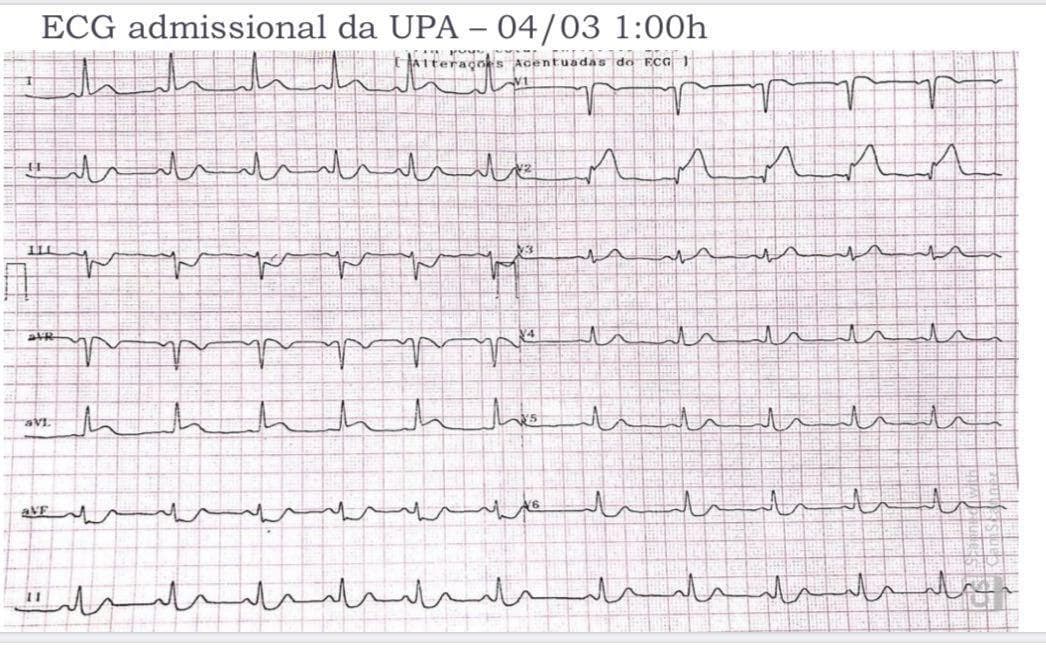 Mujer de 49 años hipertensa que comienza con ángor de reposo atribuible a disección espontánea de la DA proximal que luego se extiende a TCI y Cx