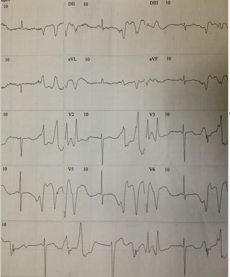 Mujer de 69 años en tratamiento con antimoniato de meglumina por una leishmaniasis cutánea que presenta episodios sincopales y gran astenia y debilidad en quién se constata severa hipopotasemia con posterior desarrollo de ondas T de memoria cardíaca