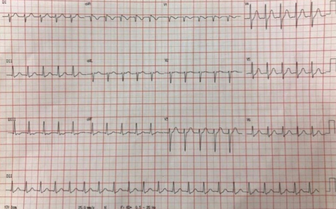 ECG correspondiente a una taquicardia por reentrada intranodal típica (TRIN) que responde a adenosina. Nótese las flechas  indicando Ia onda P retrógrada y el patrón de seudobloqueo de rama derecha en la derivación V1 . El RP es <80 ms