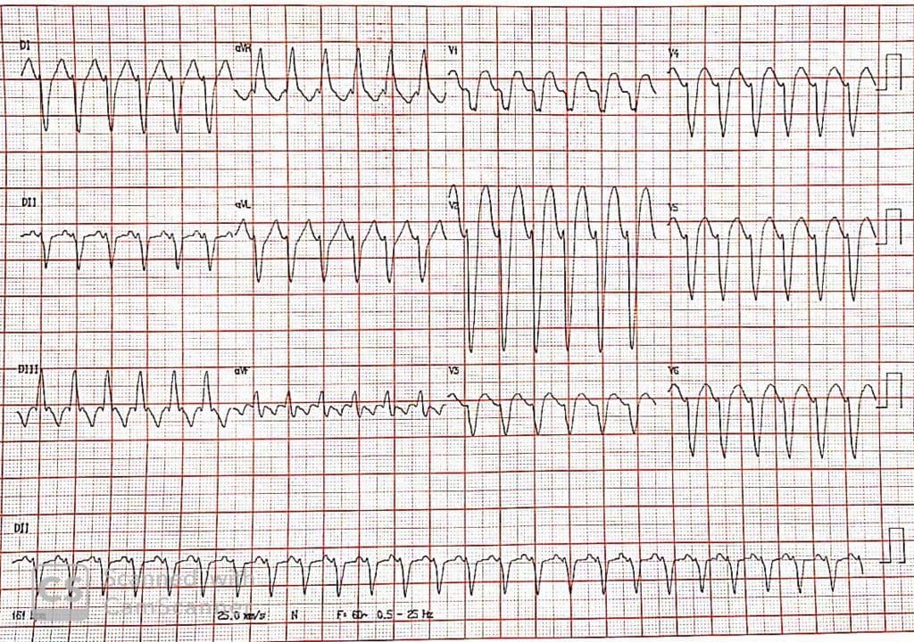 Paciente portador de miocardiopatía dilatada que presenta taquicardia erróneamente interpretada como TV y es tratado con amiodarona dejando en evidencia un aleteo auricular 2:1
