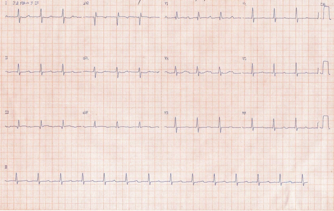 Mujer de 40 años con palpitaciones por ocurrencia de taquicardia auricular 2:1 en la que puede constatarse la regla de Bix debida a presencia de un sarcoma de aurícula izquierda