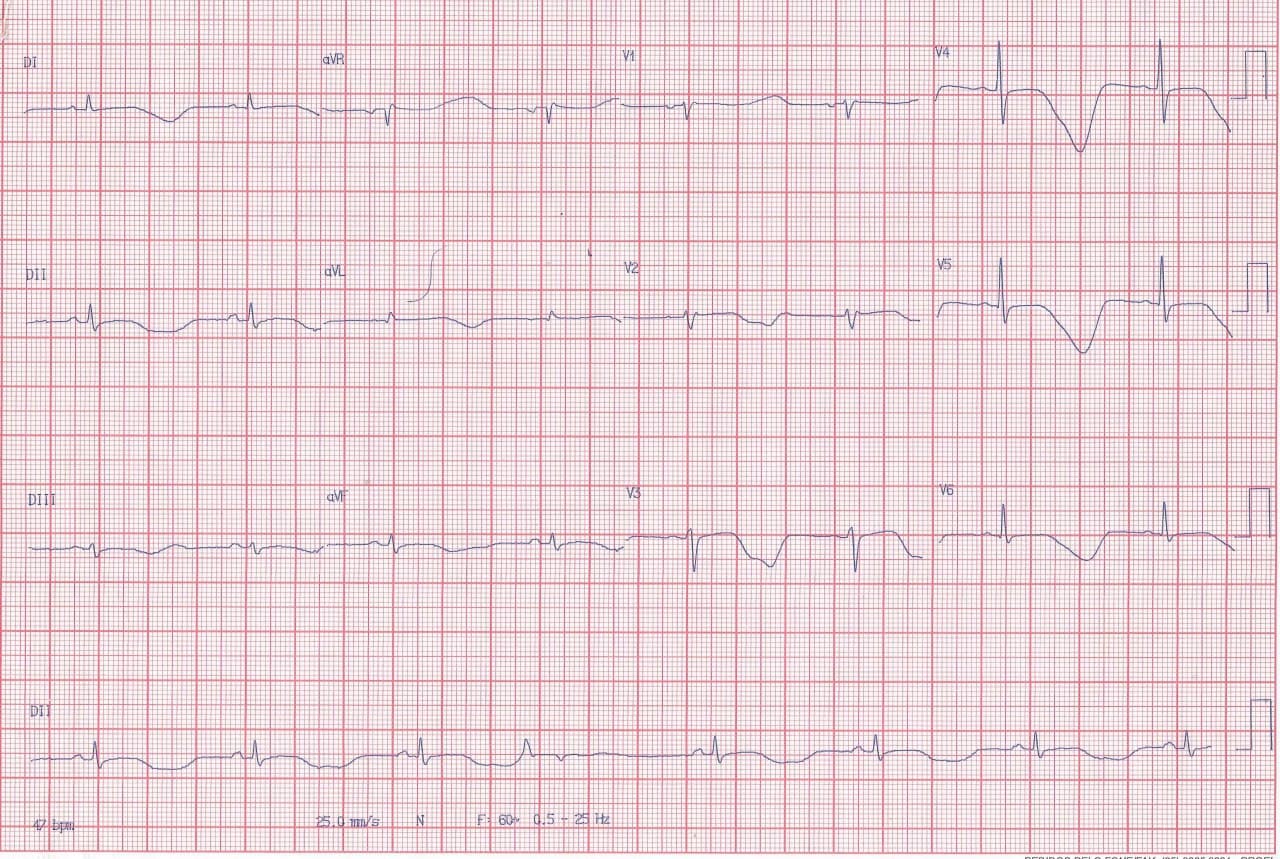 Paciente de 34 años que presenta reiterados síncopes desde la infancia por ser portador de SQTL congénito y episodios de Torsades de pointes