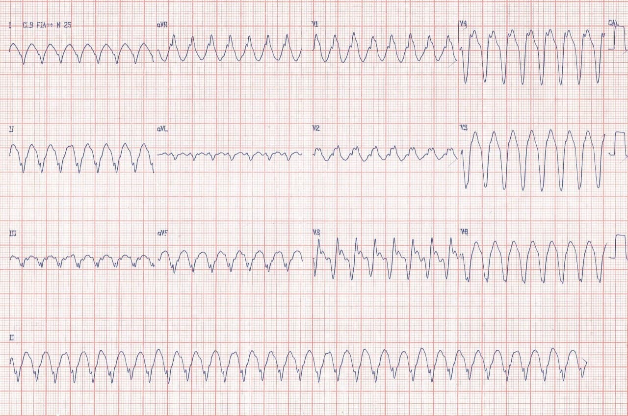 Hombre de 64 años con inestabilidad hemodinámica por TV sugerida por  ondas R monofásicas en V1 y en aVR, ausencia de complejos tipo rS o RS en precordiales y complejos QS en V6 y en quién la presencia de complejos QR en V3 y los complejos QS en V5 y V6 indican presencia de enfermedad coronaria y un aneurisma ánterolateral