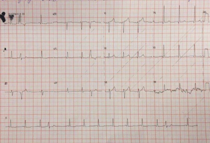 Hombre de 46 años hipertenso severo mal controlado que presenta intenso dolor interescapular lacerante seguido de síncope por presentar disección aórtica tipo B con ruptura de aneurisma que genera un hemotórax y es tratado con endoprótesis