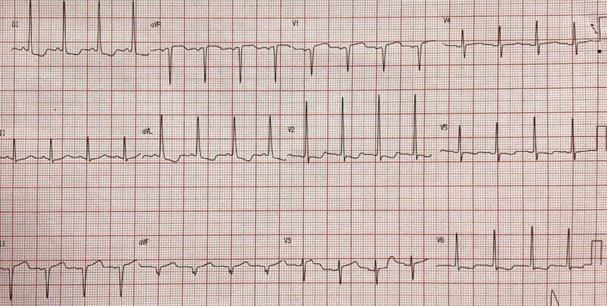 Hombre de 66 años hipertenso y diabético con antecedente de implante de stent a la DA hace 6 meses que presenta angor y disnea con presencia de BDAM agudo en el ECG, que requiere angioplastia del stent ocluído
