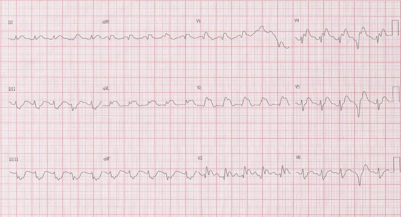Paciente de 34 años usuario habitual de cocaína que presenta episodio de ángor por presencia de trombo en DA antes de la rama septal