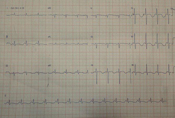 Hombre de 68 años portador de estenosis aórtica severa que manifiesta ángor y en quién además se constata obstrucción severa del tronco de la coronaria izquierda