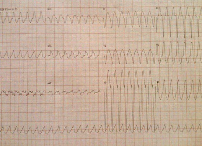 Trazado que muestra una taquicardia de QRS ancho con FC cercana a 220 lpm con respuesta a MSC con despolarización inicial muy rápida que sugiere origen SV y que corresponde a aleteo auricular