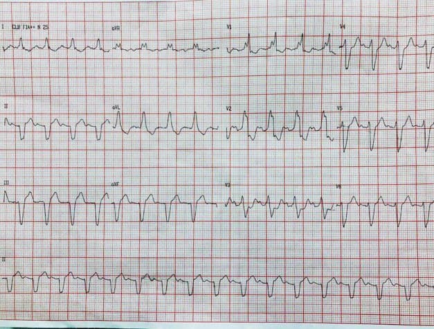 Paciente portador de miocardiopatía dilatada con CCG normal que presenta bloqueo trifascicular con patrón de «bloqueo de rama enmascarado»