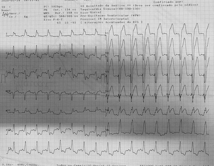 Paciente de 75 años portador de BRI crónico que consulta por malestar general, náuseas y vómitos por presentar SCA por oclusión de la DA con criterios de Sgarbosa modificado +