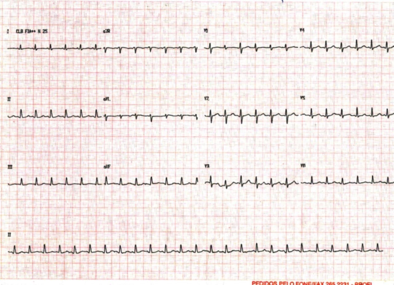 Paciente portador de derrame pleuropericárdico por metástasis pericárdicas de carcinoma de pulmón