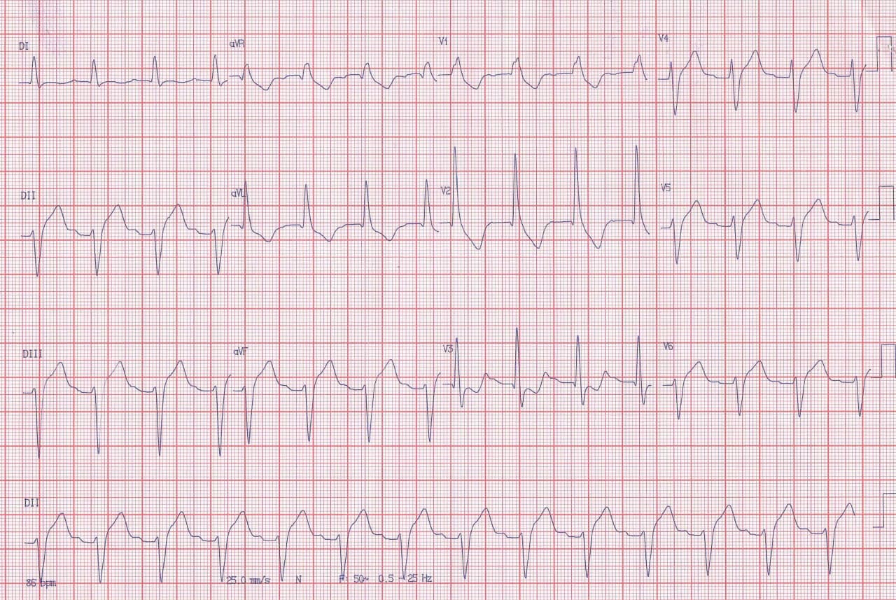 Paciente hipertenso de 63 años que presenta dos episodios sincopales cuyo ECG muestra BCRD + BDAS + BDAM + PR prolongado sugiriendo bloqueo tetrafascicular