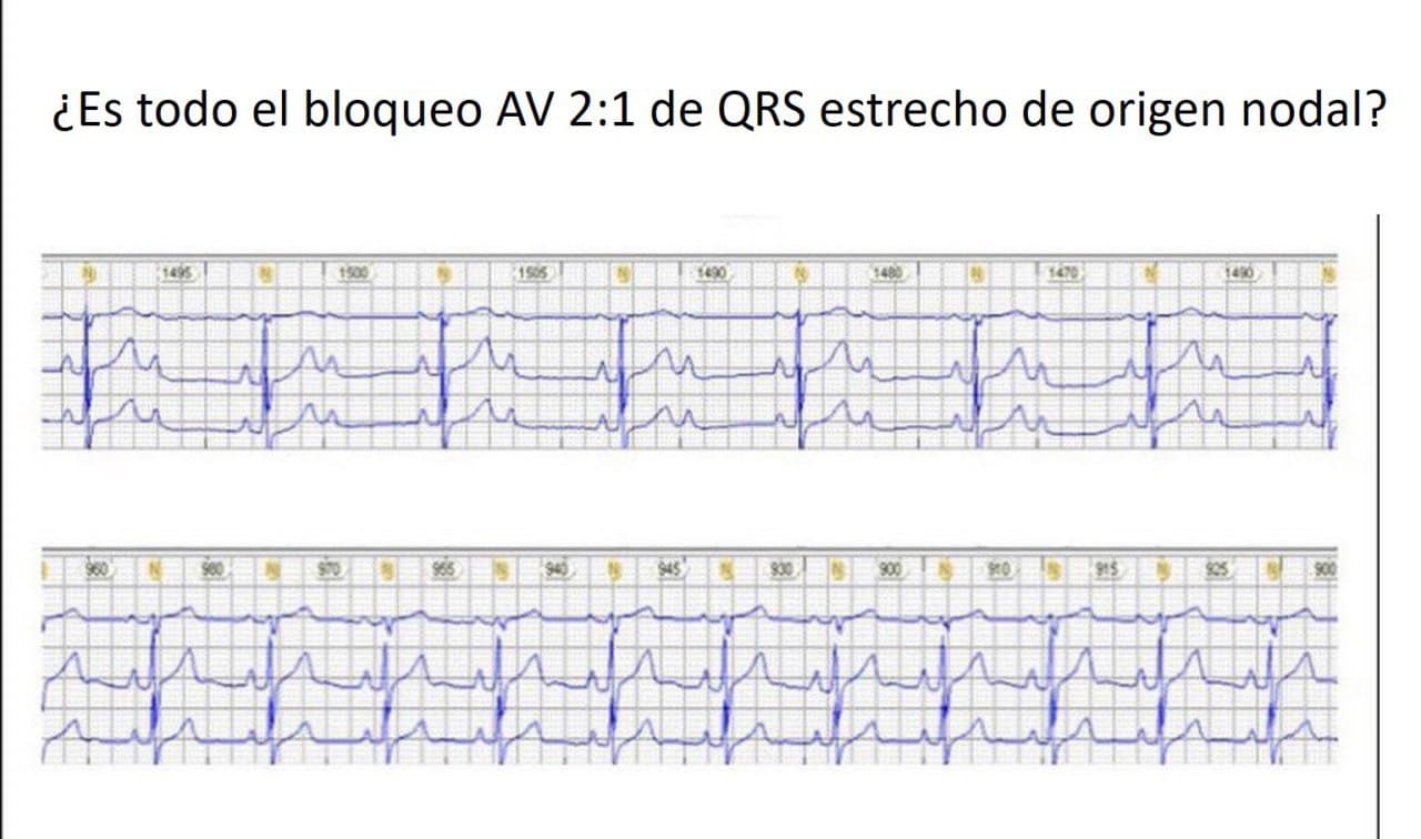 Trazado que presenta un BAV 2:1 que mejora durante el sueño a 1:1 lo que descarta localización nodal y avala localización hisiana del bloqueo