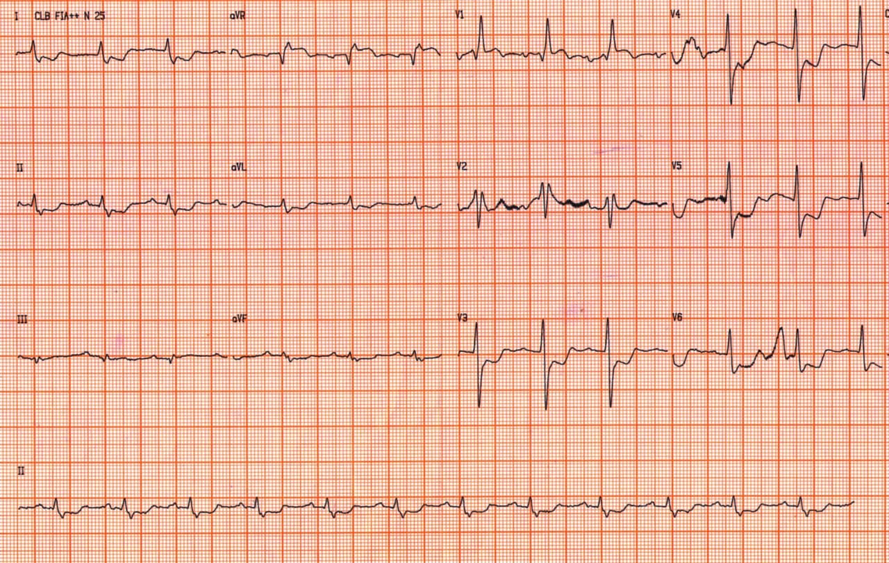 Paciente cursando SCA por compromiso de TCI distal, DA proximal y Cx proximal