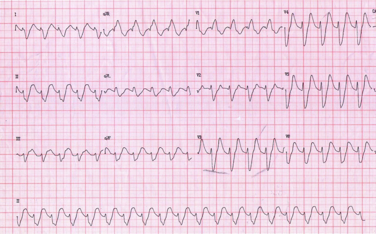 Paciente masculino de 50 años, diabético tipo II que presenta epigastralgia, náuseas y  vómitos que concurre con taquicardia de complejos anchos que resulta ser una TPSV con aberrancia a punto de partida en severa hiperK por IRC que se corrige