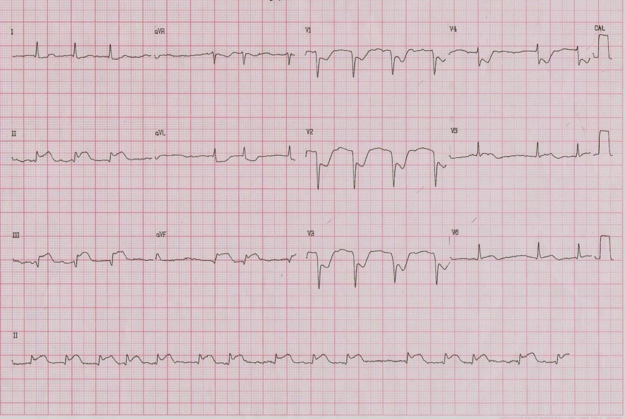 Paciente masculino de 78 años que presenta ángor prolongado por SCA originado en Cx ocluída con trombo + DA = oclusión de 90% y oclusión de CD de 90% con evolución al óbito