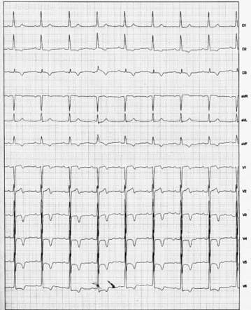 Mujer de 80 años a quién se implantó MP doble cámara por enfermedad del nódulo sinusal cuyo ECG presenta onadas T de memoria cardíaca