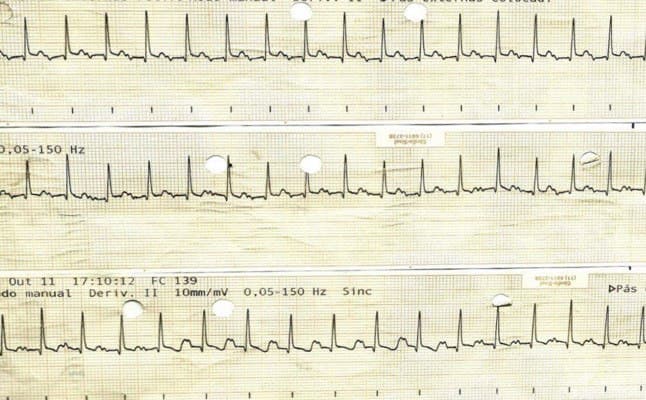 Paciente masculino de 47 años con antecedentes de internaciones previas por insuficiencia cardíaca que presenta disnea progresiva y palpitaciones en quién se constata taquicardia auricular que produce taquimiocardiopatía, arritmia  que es ablacionada, lográndose reversión de los signos de insuficiencia cardíaca
