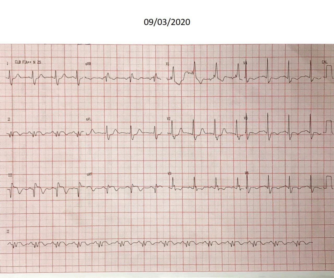 Paciente masculino de 59 años que presenta IAM de cara inferior complicado con BCRD por compromiso de CD