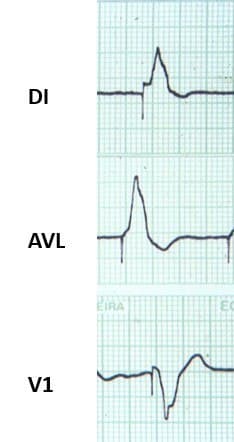 Hombre de 77 años con antecedente de implante de MP VVI que presenta dolor en hemitórax izquierdo y disnea por cursar SCA por oclusión de 1º rama marginal de la Cx