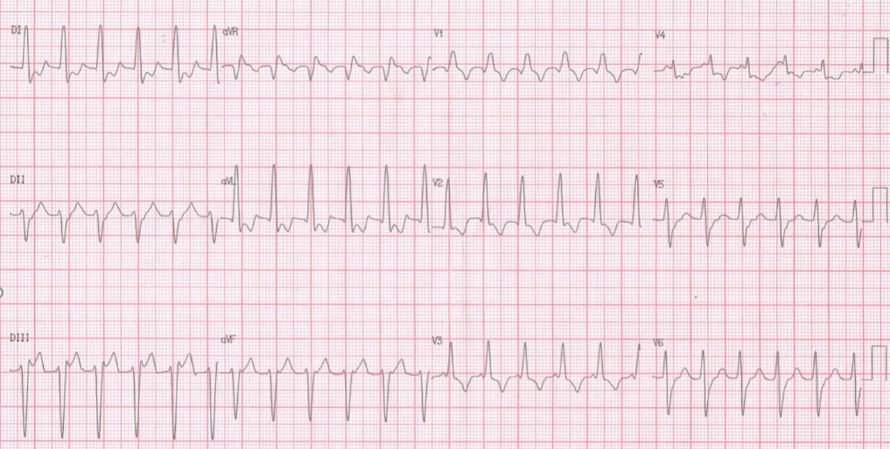 Mujer de 54 años portadora de miocardiopatía dilatada que cursa con taquicardia de QRS ancho  con un patrón de BRD, bloqueo fascicular anterior izquierdo, y quizás también  fascicular septal izquierdo (R prominente en V2) con reversión espontánea