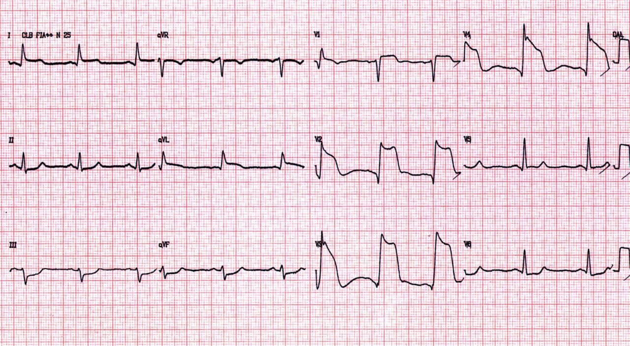 Paciente masculino de 41 años consumidor de cocaína que presenta SCA cuya CCG es normal por vasoespasmo en la DA que cede con nitroglicerina