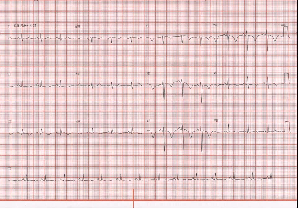 Paciente masculino de 32 años que cursa con precordialgia y disnea progresivas por TEP bilateral en portador de síndrome antifosfolipídico
