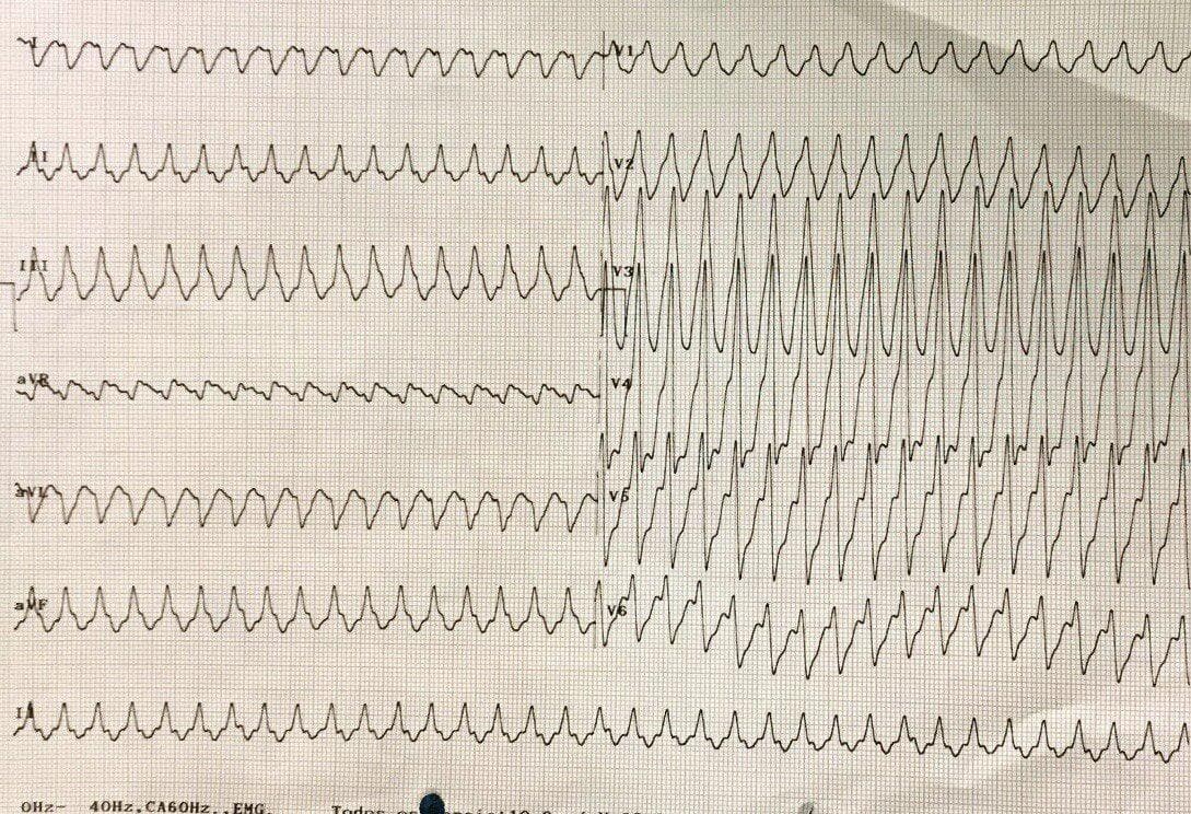 Paciente masculino de 66 años portador de miocardiopatía chagásica que presenta una TV epicárdica