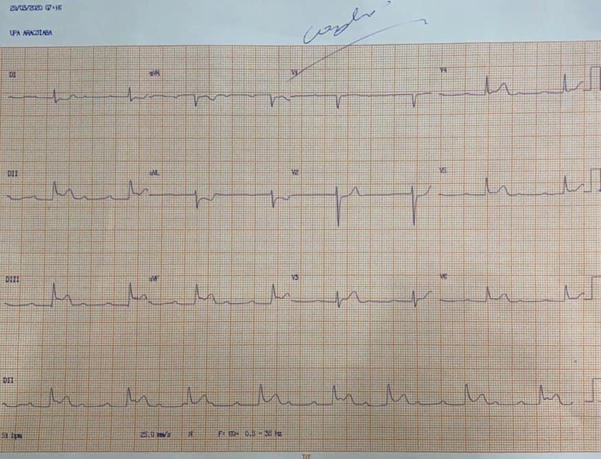 Hombre de 77 años que presenta ángor prolongado por SCA que compromete la CD proximal, con BAVC, y posterior colocación de stent con revascularización exitosa