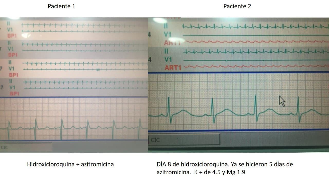 ECG de dos pacientes COVID + tratados con hidroxicloroquina + azitromicina que muestran respectivamente QT prolongado con riesgo de desarrollar arritmias ventriculares