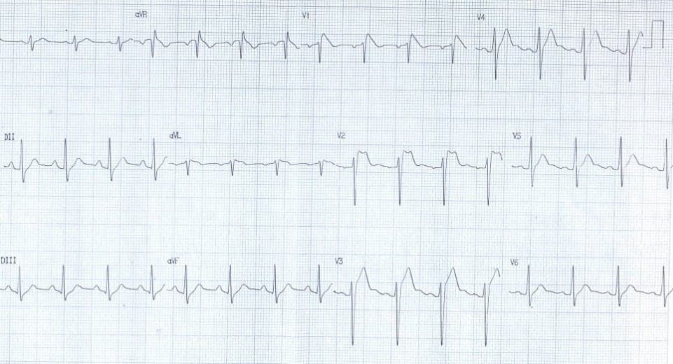 Paciente masculino de 27 años con historia familiar de muerte súbita que presenta episodios sincopales recurrentes que durante episodio febril durante la epidemia de H1N1 muestra un síndrome de Brugada desenmascarado por la fiebre