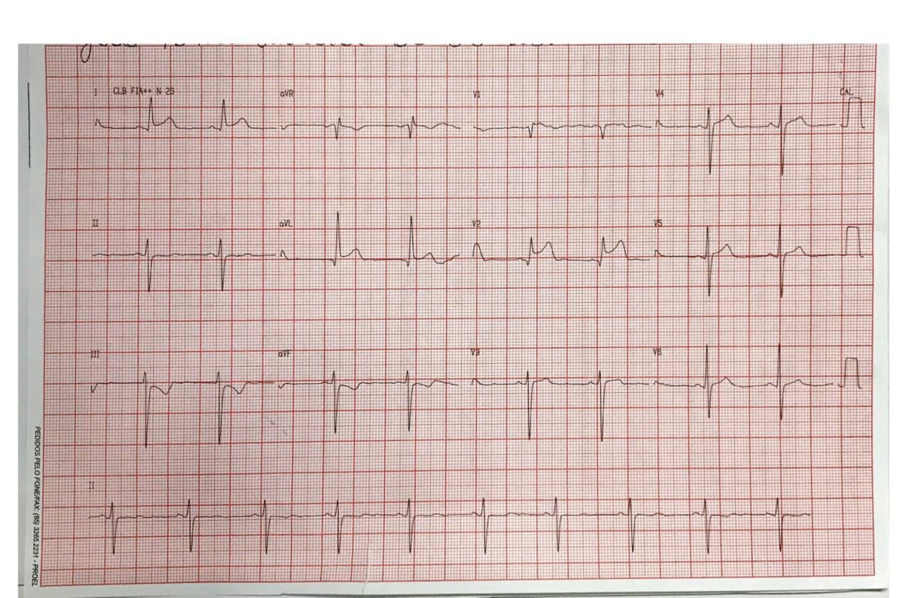 Hombre de 63 años con múltiples factores de riesgo que presenta episodio de ángor prolongado debido a SCA por compromiso de 1º diagonal