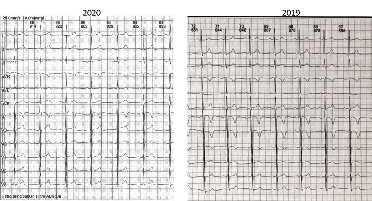 Mujer de 71 años, hipertensa, que presenta bloqueo interauricular progresivo asociado,  en el contexto de miocardiopatía hipertrófica