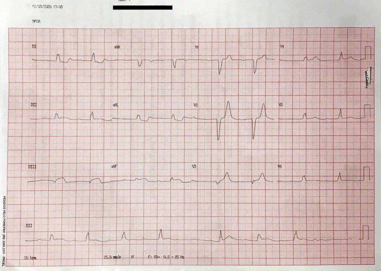 Trazado correspondiente a paciente con SCA que presenta BAVC  debido a enfermedad coronaria de tres vasos