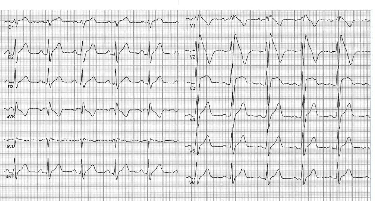Dos pacientes portadores de síndrome de Brugada que presentaron TV polimórfica y FV en el estudio electrofisiológico, muestran como factores de riesgo adicionales, fQRS el primer trazado y repolarización precoz el segundo