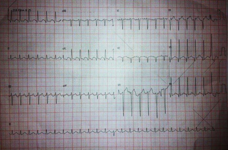 Hombre de 75 años hipertenso y diabético que presenta taquicardia auricular 2:1 que no responde al MSC y sí en cambio a la adenosina EV