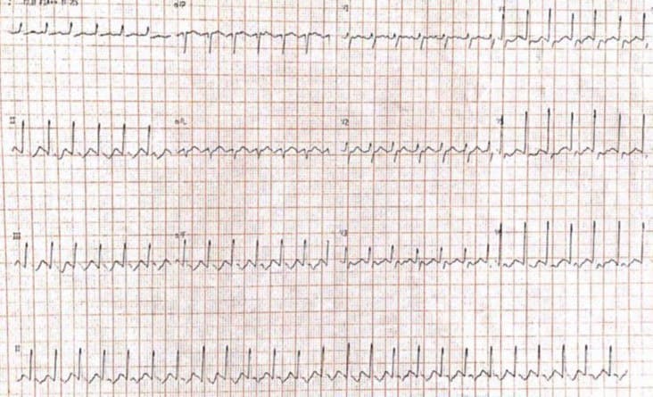 Mujer de 61 años con antecedente sincopal hace 6 años que repite episodio similar motivado en probable aleteo auricular 1:1