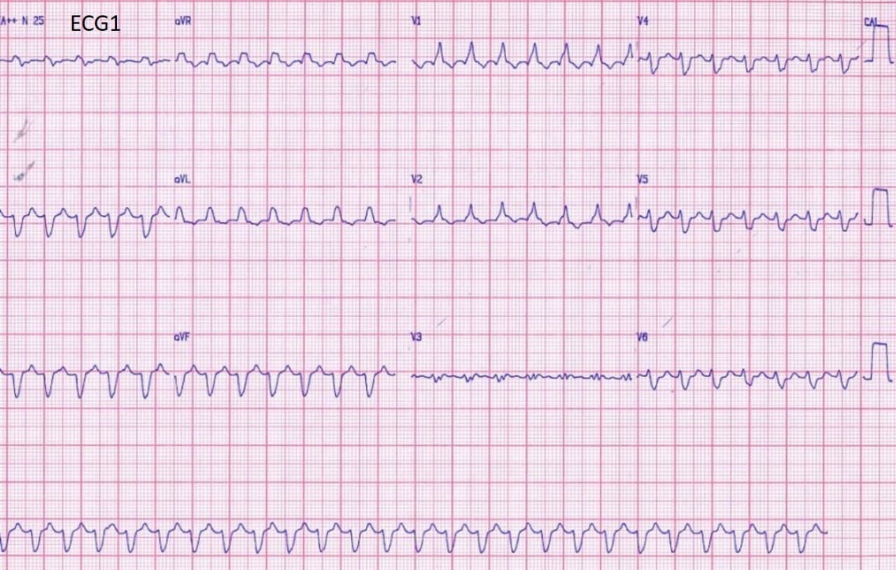 Hombre de 74 años que hace 9 días presentó cuadro de IAM que se complica con TV que evoluciona a aleteo ventricular y FV que requiere CVE