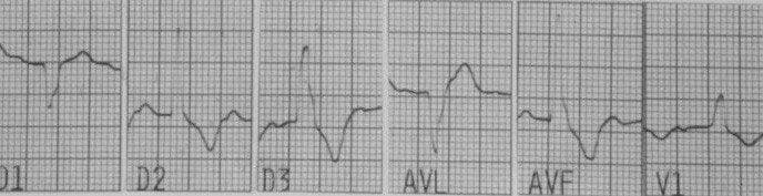 Paciente de 57 años que presenta episodio sincopal por presencia de bloqueo trifascicular que requiere colocación de MP transitorio que muestra pérdida de captura