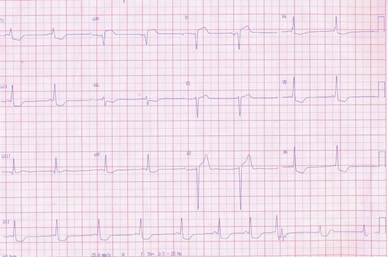 Hombre de 60 años portador de enfermedad de Chagas que concurre a emergencias por dolor precordial y disnea desde hace tres meses que presenta taquicardia de QRS ancho acompañada de hipotensión que requiere CVE y que muestra CCG normal