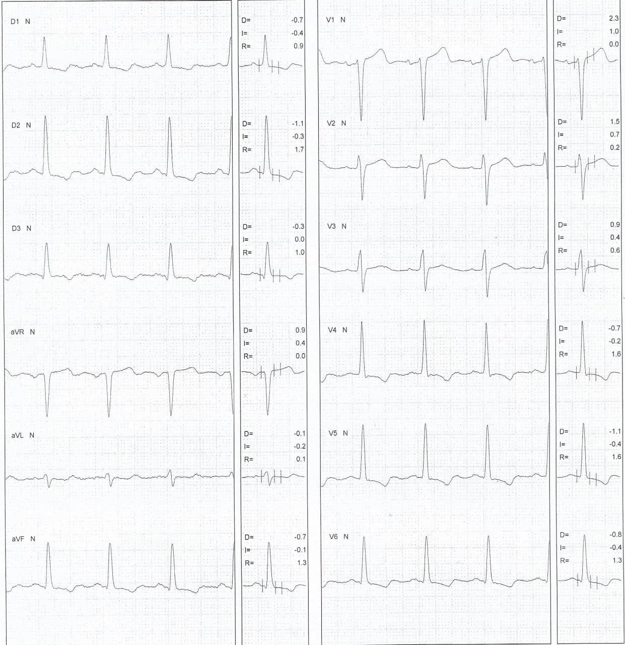 Hombre de 59 años que presenta dolor precordial atípico que durante PEG repite idéntico dolor y desarrolla TV de tipo T de P y cuya CCG demostró lesión del 90% de la DA proximal