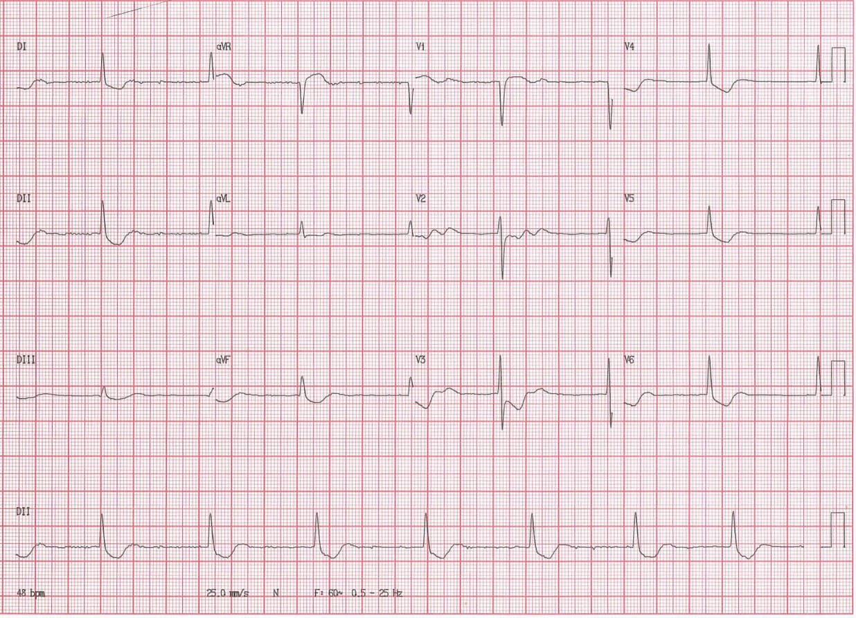 Paciente de 57 años con antecedentes de FA tratado con digoxina que presenta dolor precordial atípico, náuseas y vómitos cuyo ECG muestra ritmo de la unión como expresión de intoxicación digitálica