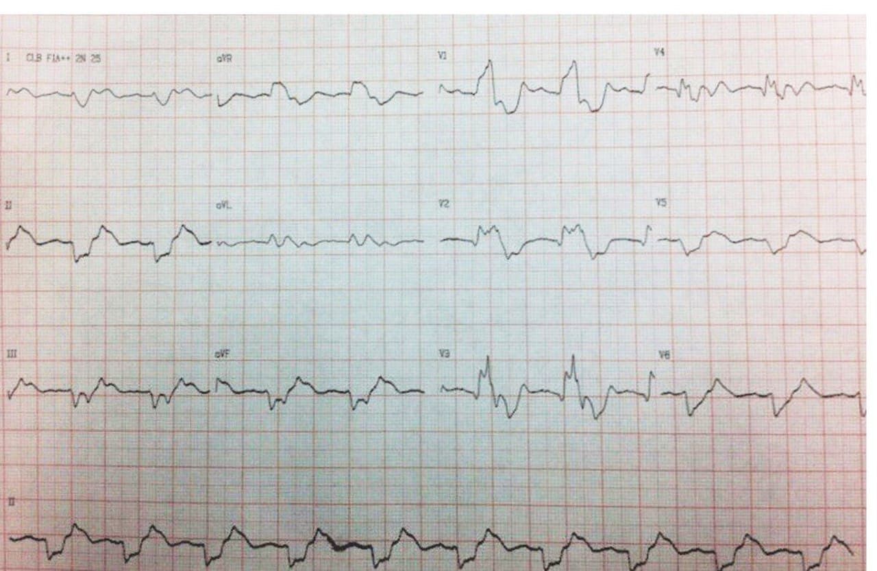 Mujer de 50 años, HTA y DBT tratada con losartan e indapamina que presenta disnea y fatiga cuyo ECG muestra complejos bizarros y en quién se constatan cifras elevadas de urea, creatinina y potasio