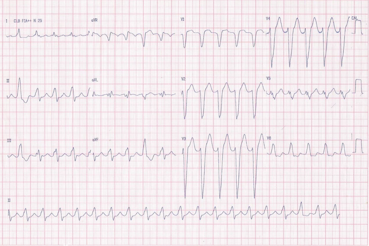 Varón de 46 años portador de miocardiopatía dilatada con severa disfunción sistólica que cursa con fatiga, hipotensión y disnea que presenta taquicardia auricular 2:1 con signos de crecimiento ventricular derecho
