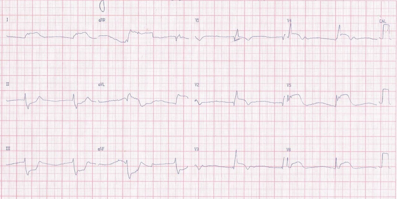 Hombre de 68 años que presenta episodio de ángor prolongado por SCA que presenta shock cardiogénico y evolución al óbito debido a oclusión de TCI cuyo ECG además muestra disociación AV