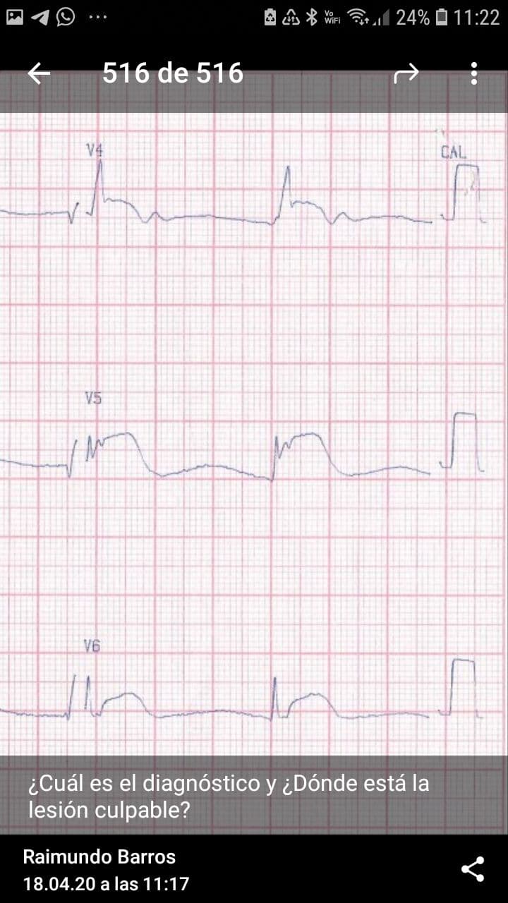 Paciente con insuficiencia renal crónica dialítica que pierde dos sesiones de hemodiálisis y cursa con cuadro de pericarditis urémica e hiperpotasemia con mejoría post diálisis